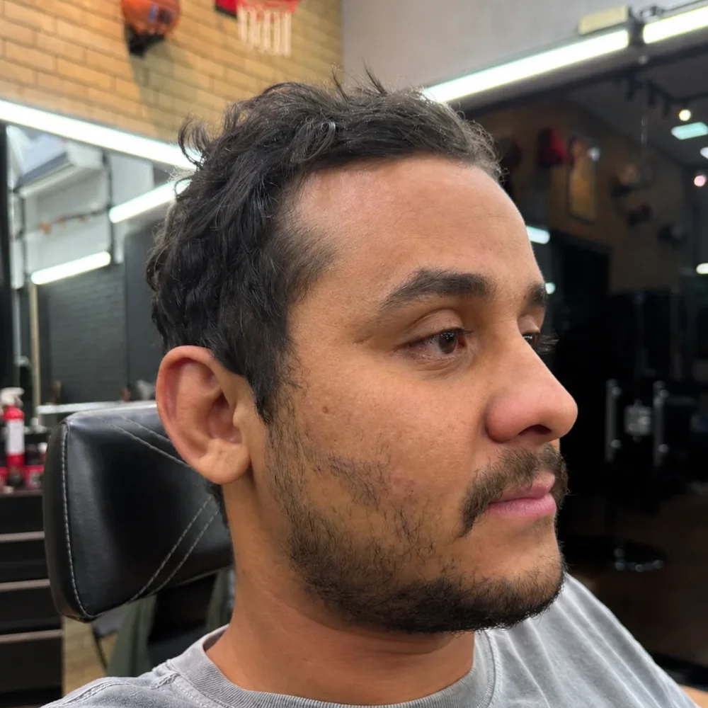 Antes: Micropigmentação de Barba na Duck's Barber