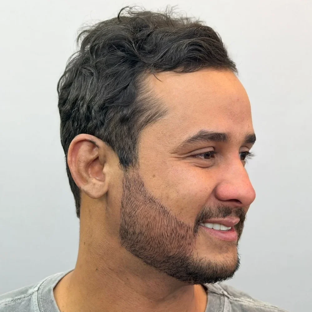 Depois: Micropigmentação de Barba na Duck's Barber